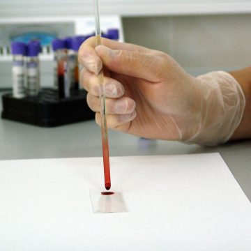 Científicos españoles ‘crean’ leucemia a partir de células sanas