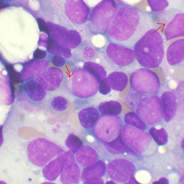 Identifican mutaciones que predicen el riesgo de leucemia mieloide aguda