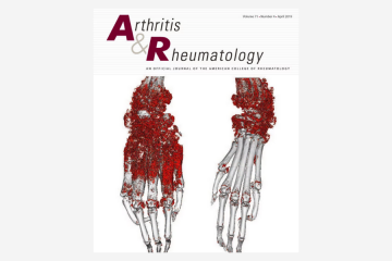 Identification of Novel Autoantibodies Associated With Psoriatic Arthritis