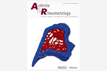 Advancing rheumatoid arthritis synovial biopsy analysis: one B cell at a time